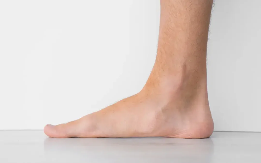 Flatfoot Explained: What You Should Know