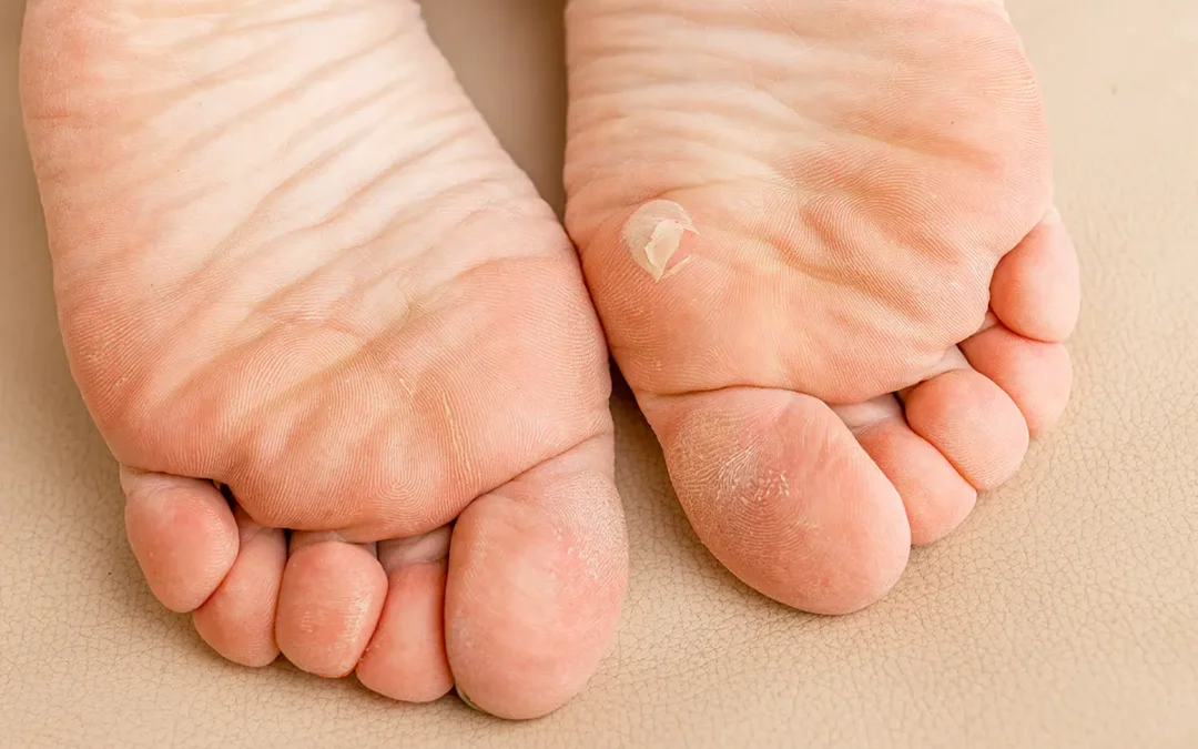 Corns: How to Effectively Manage and Prevent Them on Your Feet
