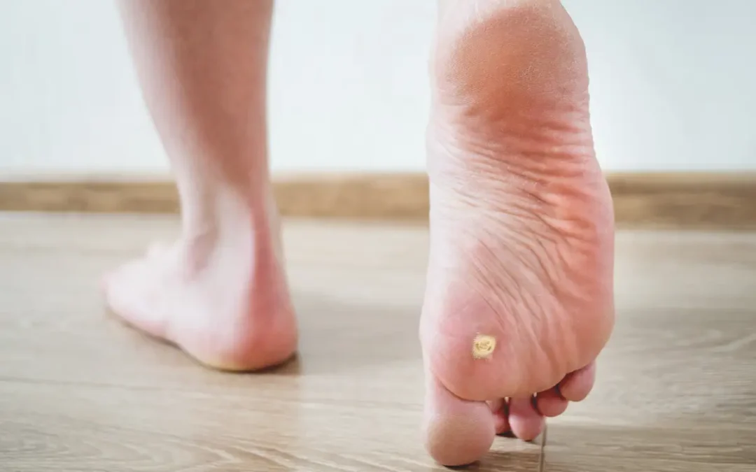 How Did I Get a Corn on My Foot? Causes and Prevention Tips
