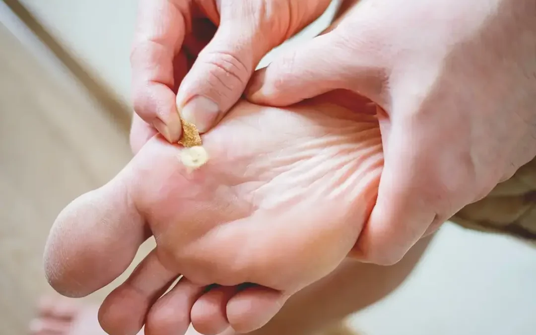 Managing Plantar Warts: Treatment and Prevention