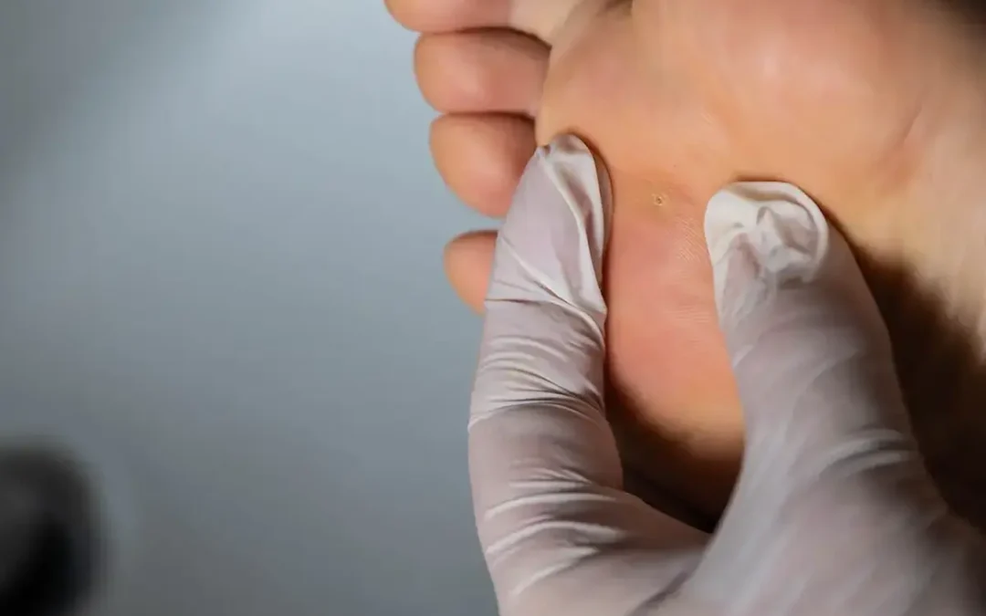 How to Treat and Prevent Plantar Warts Effectively