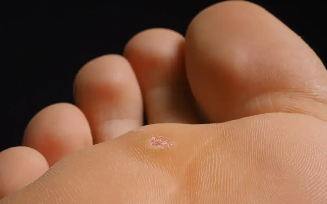 Tips for Preventing Plantar Warts