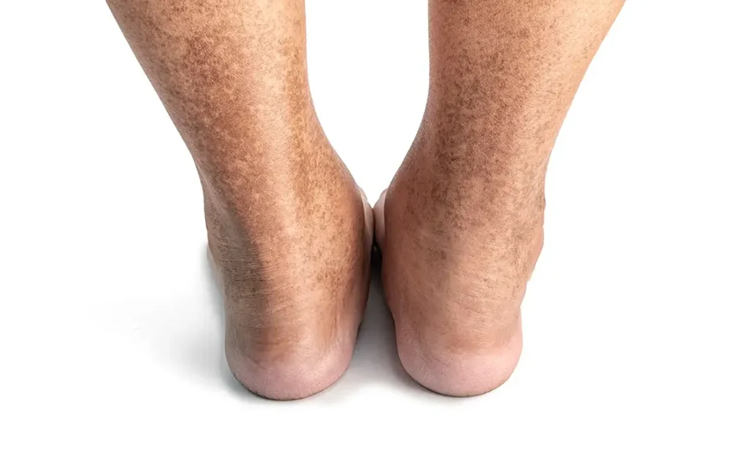 Common Diabetic Foot Conditions and How to Prevent Complications