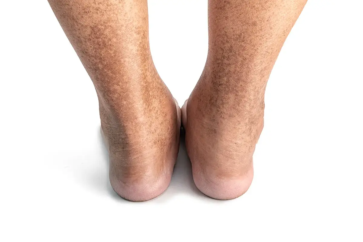 closeup skin at legs show mottled skin caused by diabetes closeup skin at legs show mottled skin caused by diabetes