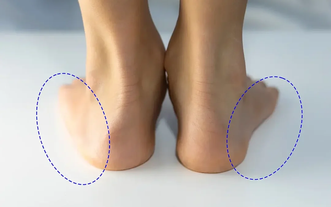 Two Main Categories of Flat Feet and Their Implications