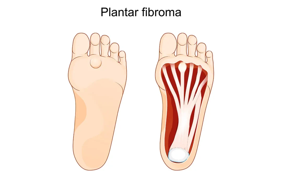 Where Is a Plantar Fibroma Located and How Does It Affect You?
