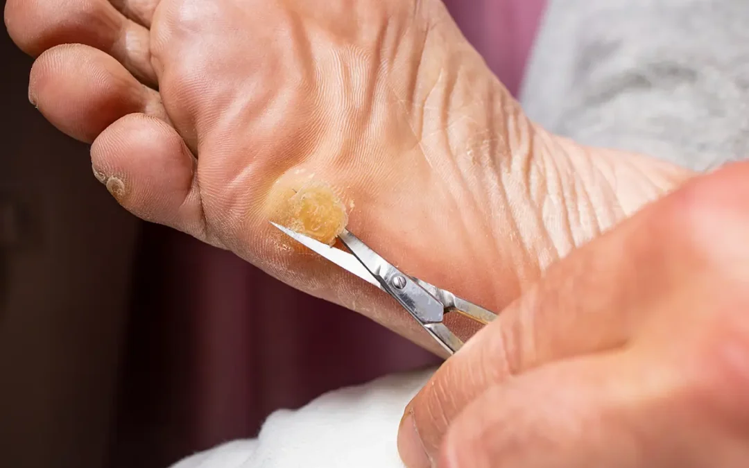 Understanding Corns and Calluses: Causes and Care Tips
