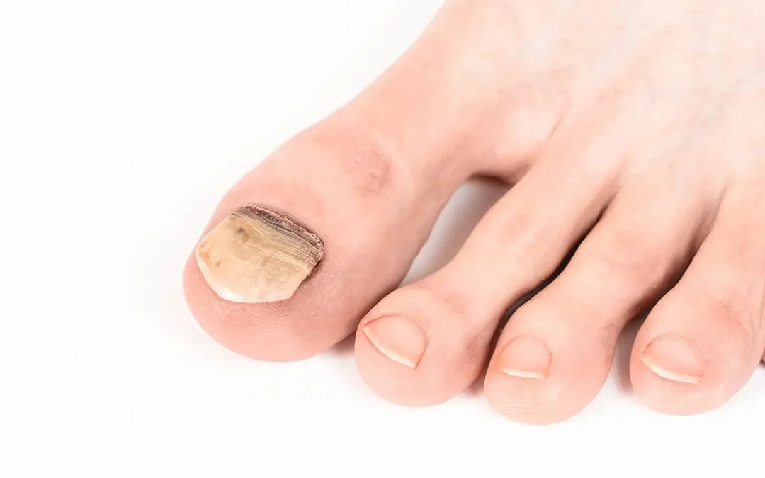 What Causes Thick Toenails and How to Treat Them