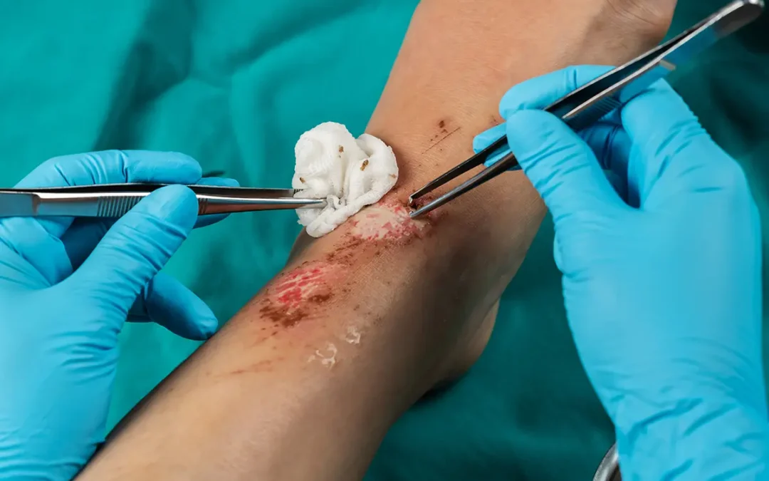 Comprehensive Wound Care for Faster Healing