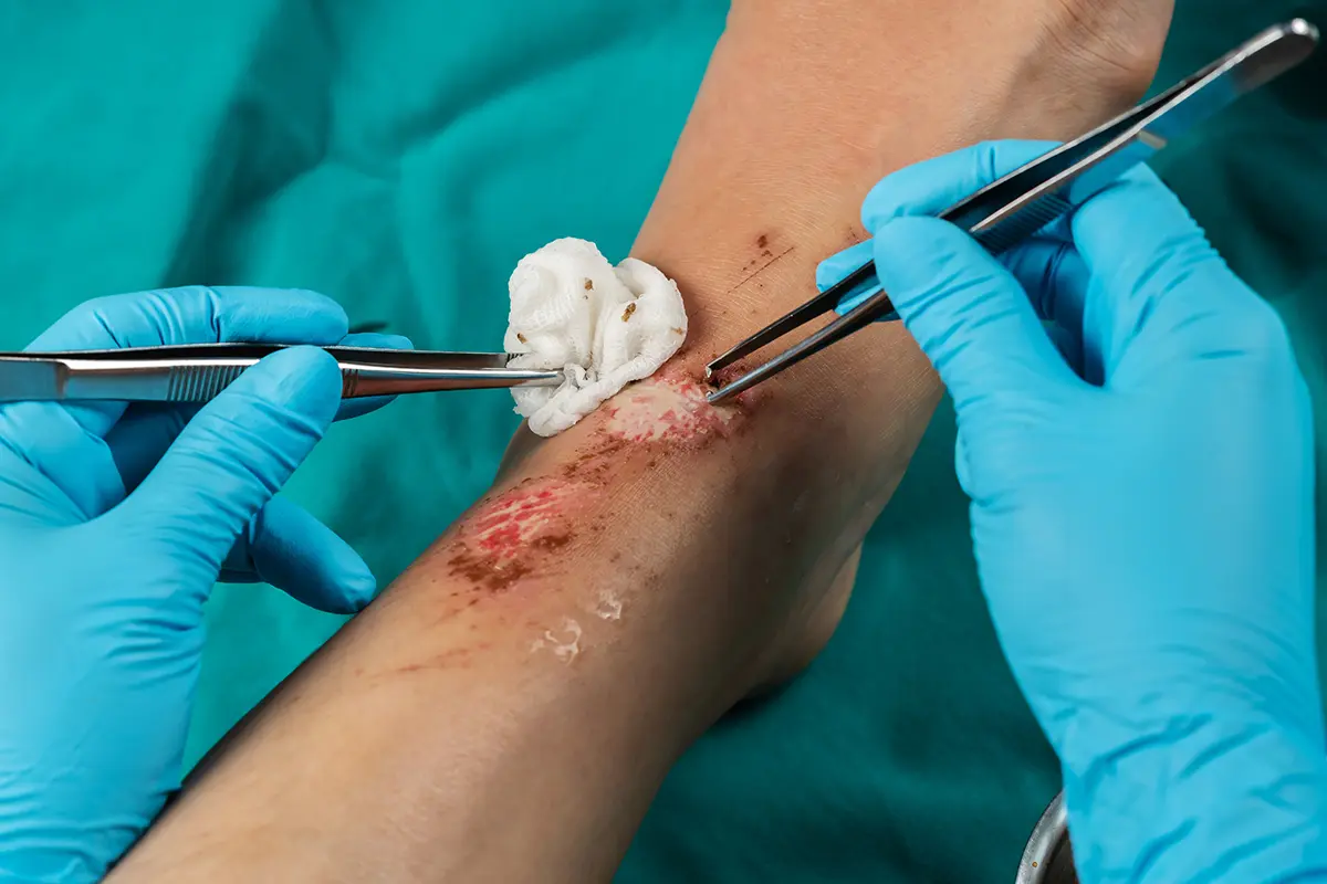 doctor cleaning wound on leg