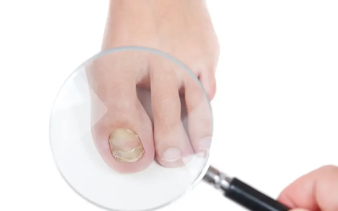 Available Treatments for Toenail Fungus