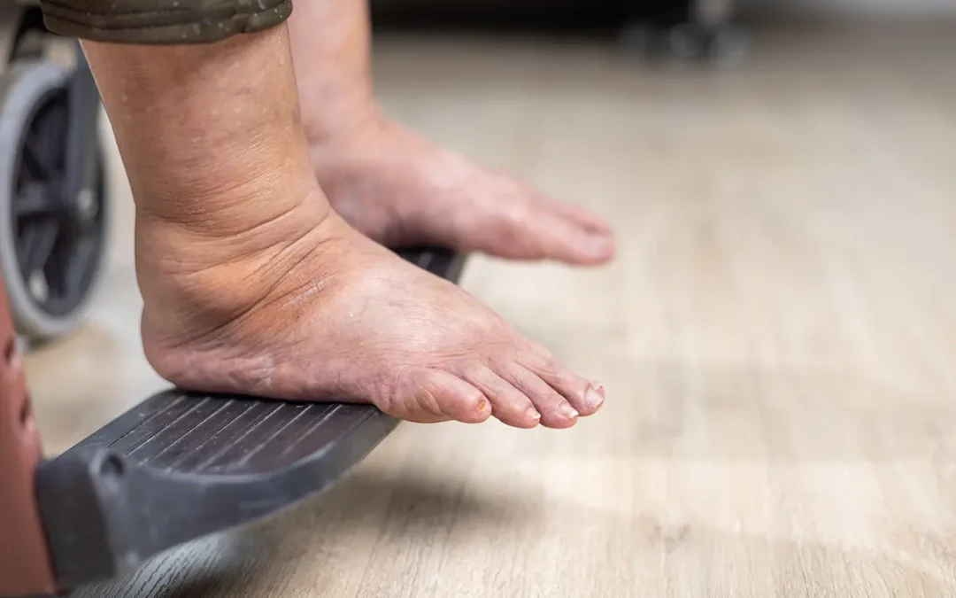Common Foot Problems in the Elderly and Their Causes