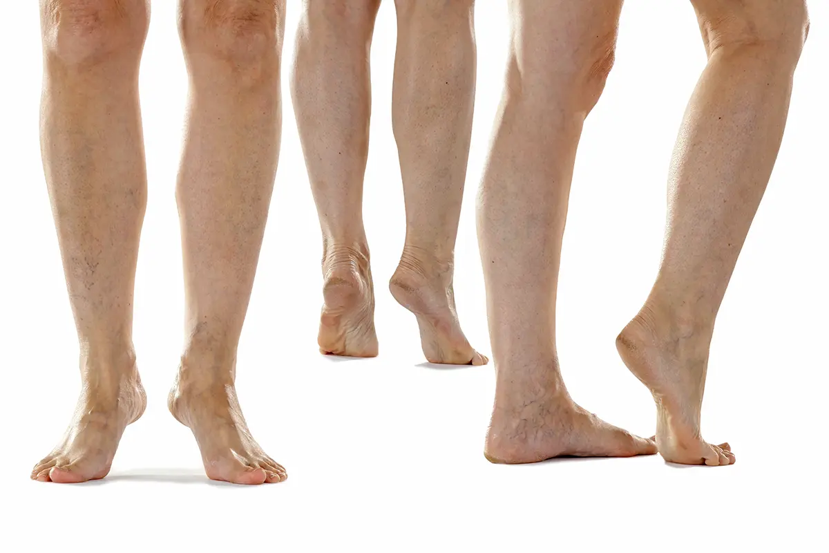 elderly womans legs and feet showing visible skin conditions such as spider veins dry and cracked heels rough skin and age related imperfections
