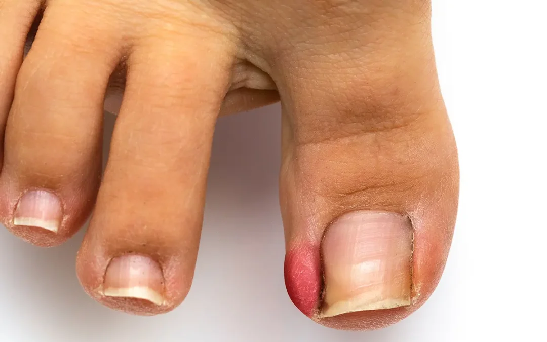 Dealing with Painful Ingrown Toenails: Prevention and Treatment