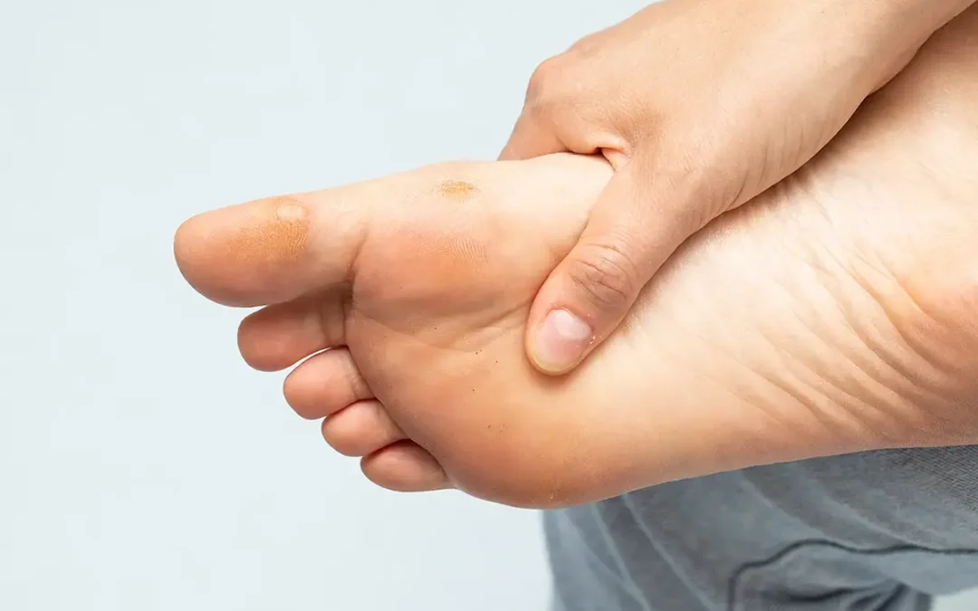 Warts on Your Feet: What They Are and How to Manage Them