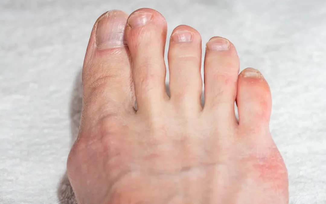 What Causes Crooked Toes and How to Prevent Them