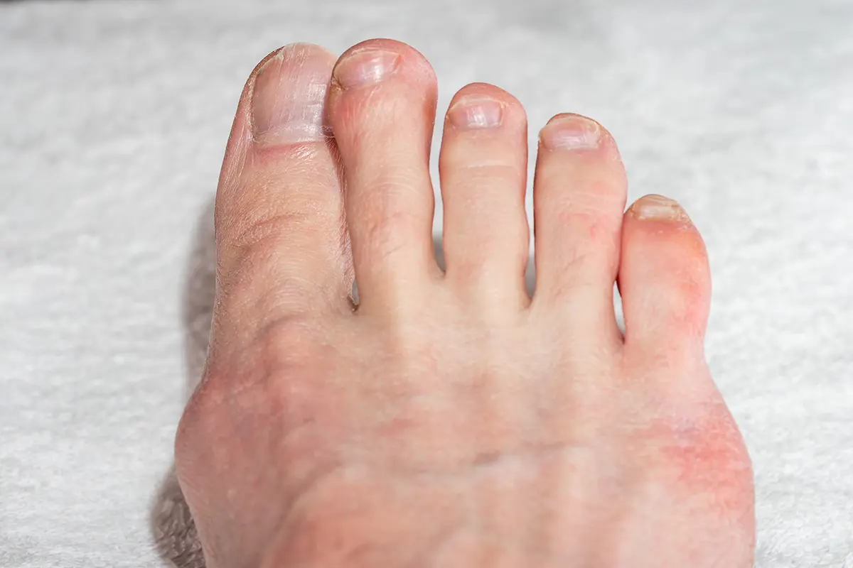 female legs with crooked toes and bunion