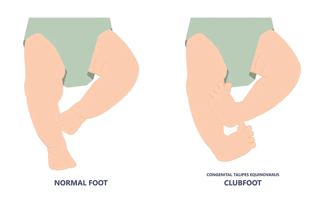 Understanding Clubfoot in Infants: Causes and Treatments