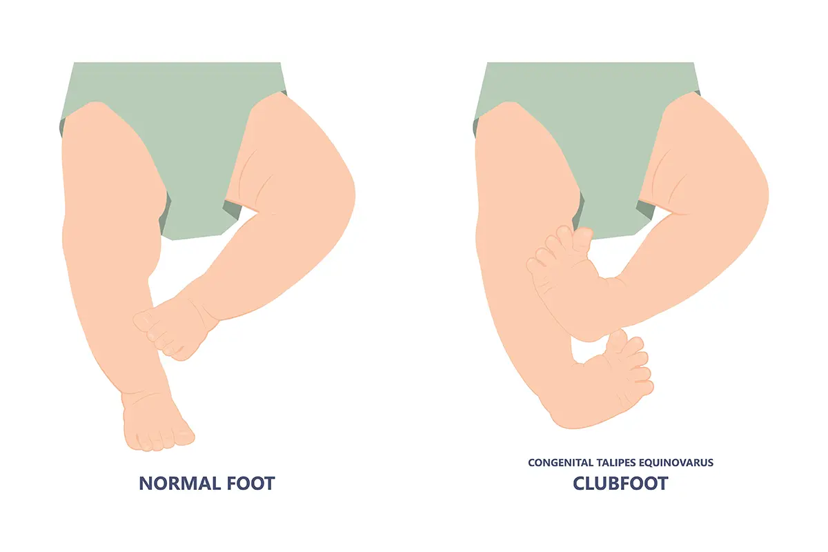 foot deformities infant turned inward upward birth baby tendon leg muscle bone twist feet foot deformities infant turned inward upward birth baby tendon leg muscle bone twist feet