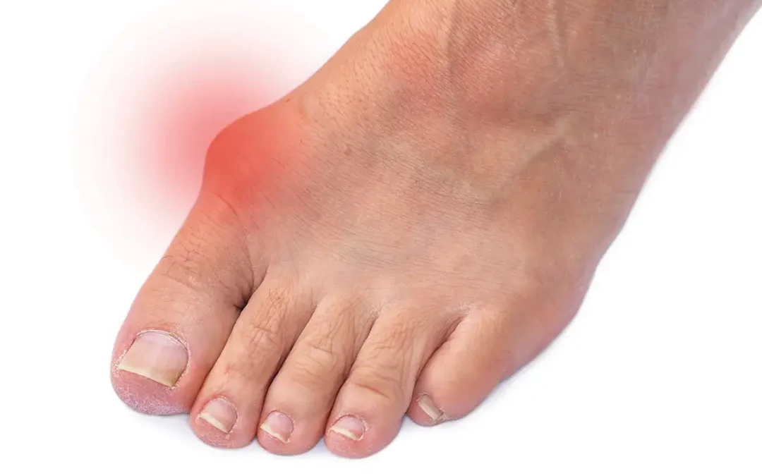 What Are Bunions? A Complete Overview