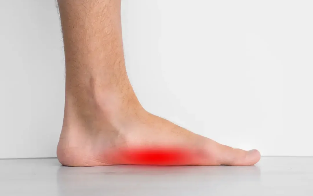 Flat Feet: What It Means for Your Foot Health