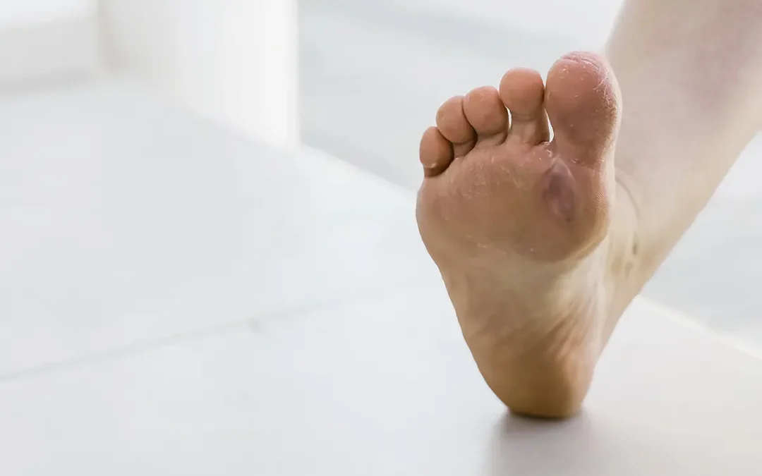 Blisters: Prevention and Treatment for Healthy Feet