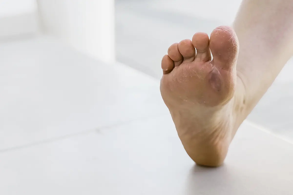 foot with blister or chafing caused by uncomfortable shoes