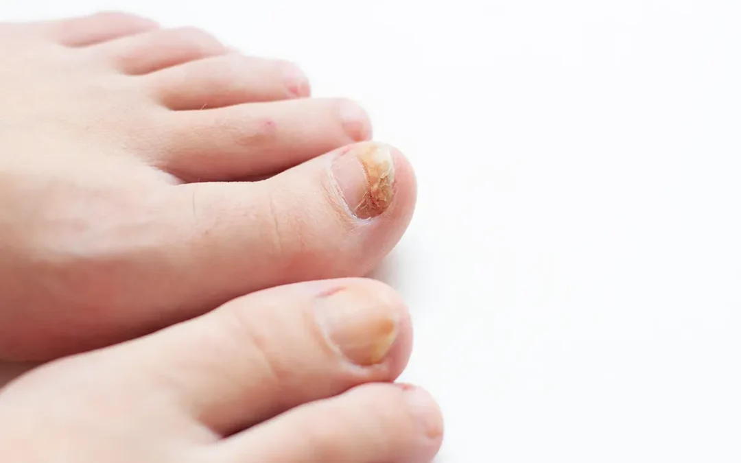 Symptoms and Causes of Tinea Unguium (Toenail Fungus)