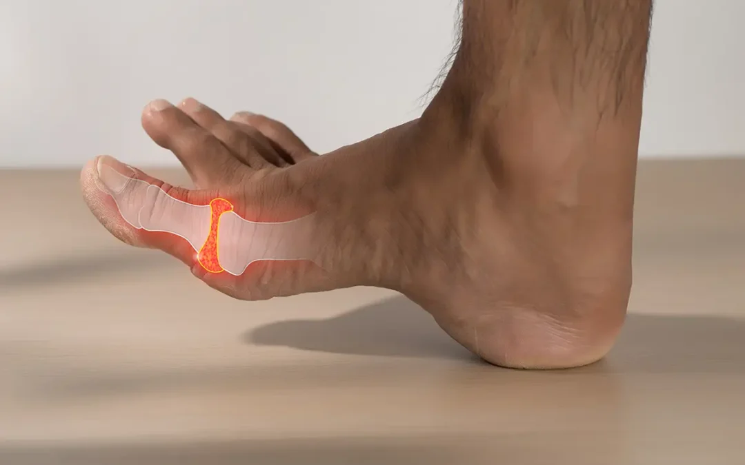 Osteoarthritis of the Big Toe: Causes, Symptoms, and Treatment