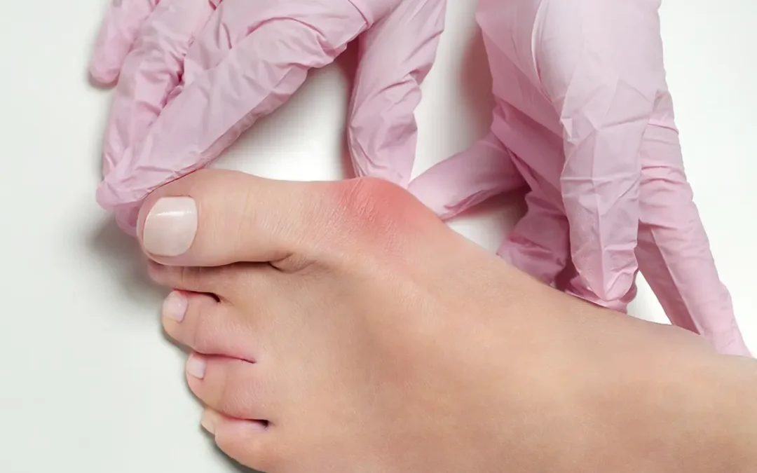 Hallux Valgus and Hallux Rigidus: What They Are and How They Affect You