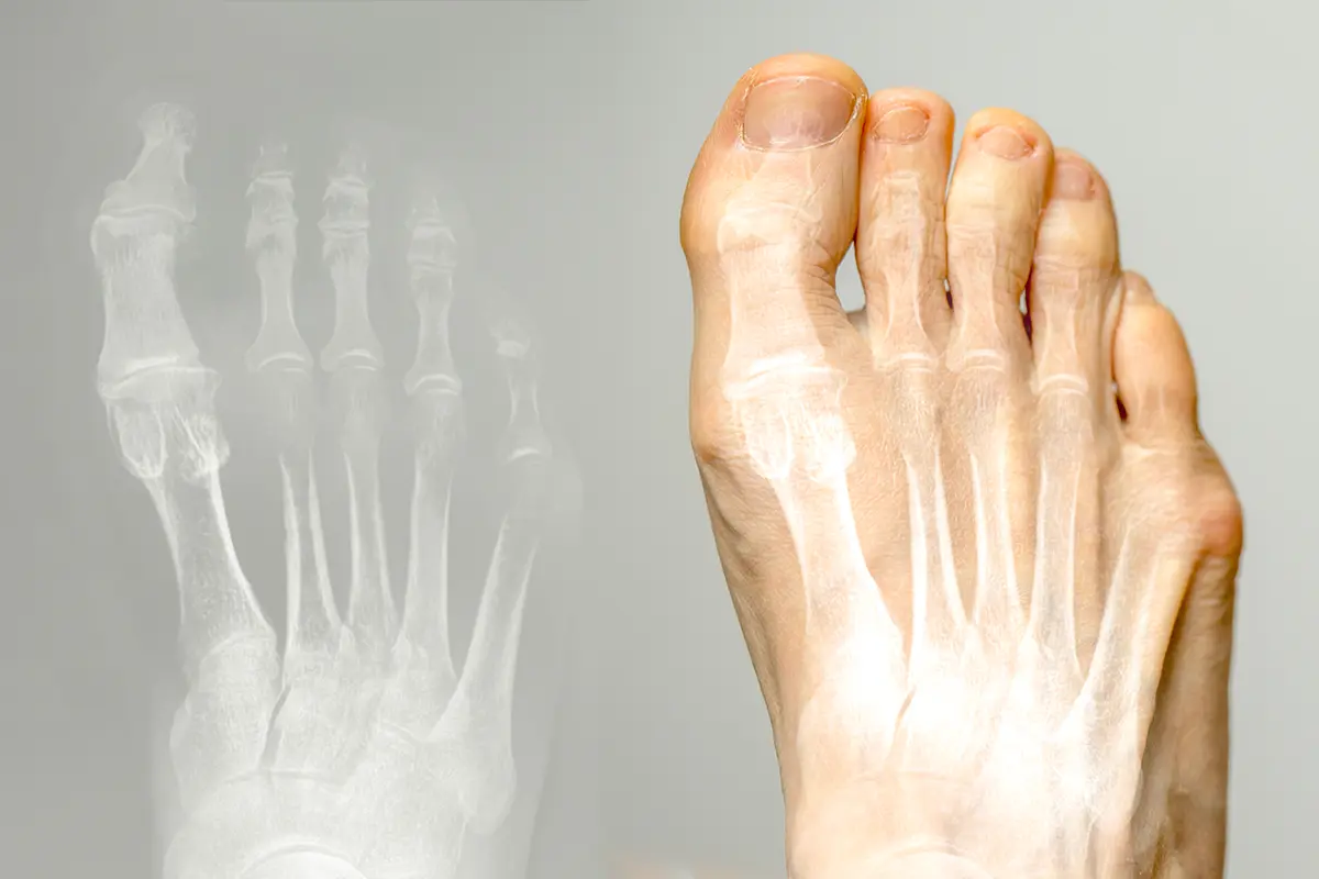 hallux varus condition