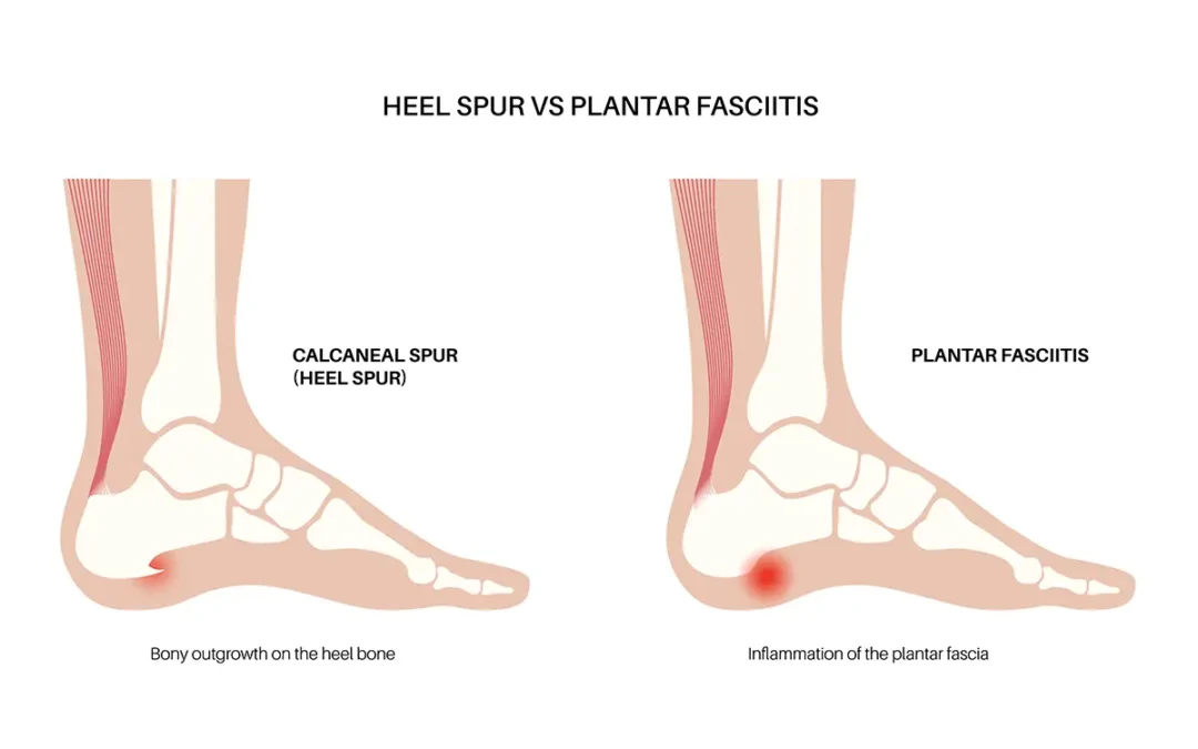 Heel Spurs vs. Plantar Fasciitis: Key Differences Explained