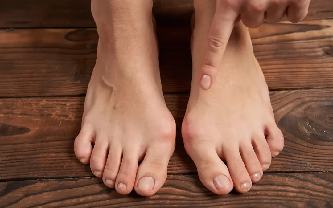 Bunions: What They Are and How to Manage Them