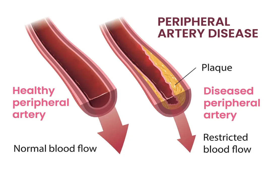 Peripheral Artery Disease: What It Means for Your Circulation and Feet