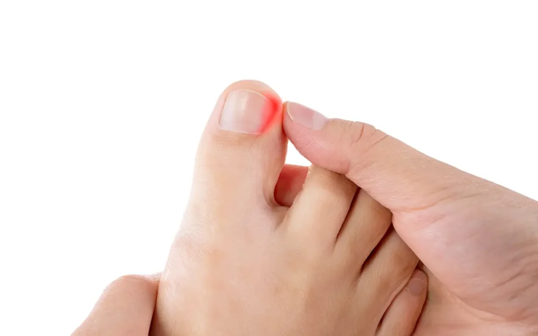 Can I Ignore My Ingrown Toenail?