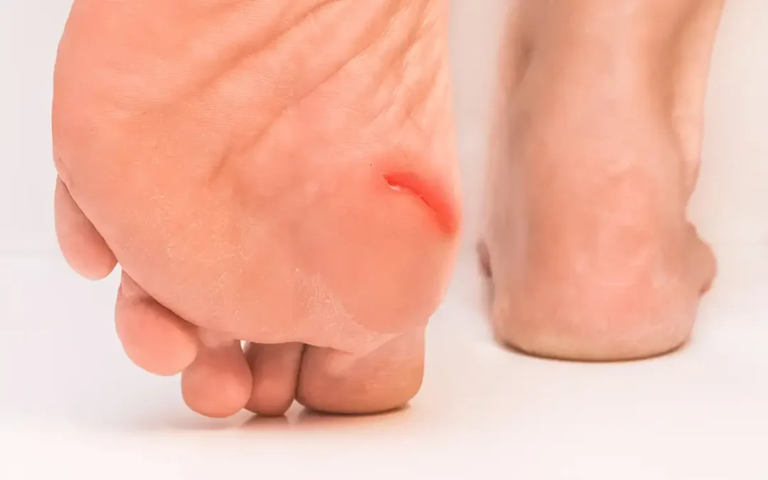 Signs That Foot Wounds Should Be Checked