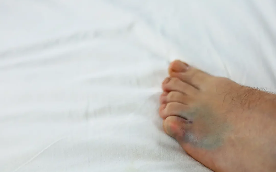 What Is a Stone Bruise? Causes and Treatment Options
