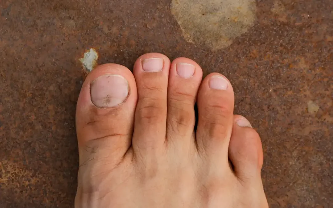 Risk Factors for Morton’s Neuroma You Should Know About