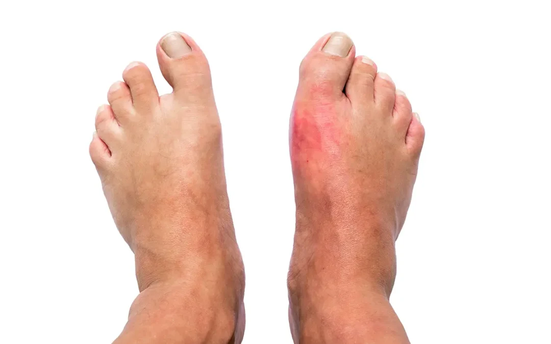What Is Gout? Symptoms and Treatment Options
