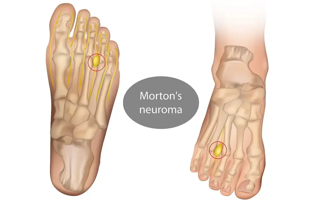 How Does Morton’s Neuroma Feel?