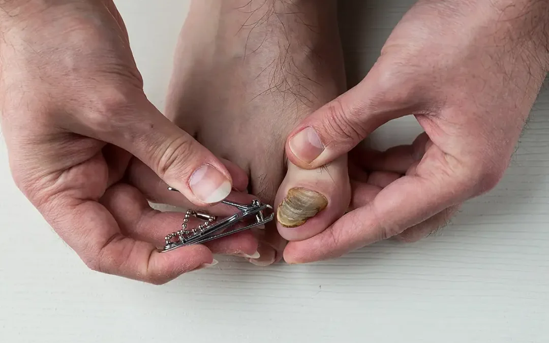 Toenail Fungus Needs Treatment: How to Recognize and Address It