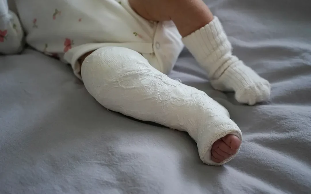 Long-Term Consequences of Untreated Congenital Clubfoot