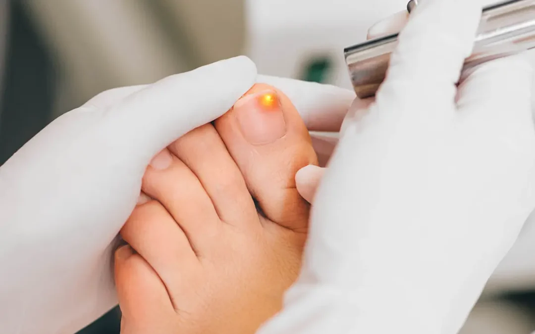 Laser Treatment for Fungal Nails: How It Works and Who Benefits