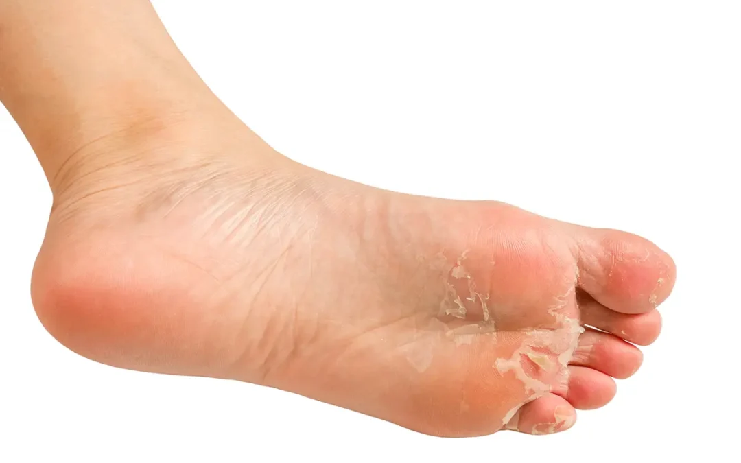 How Can Athlete’s Foot Feel Better?