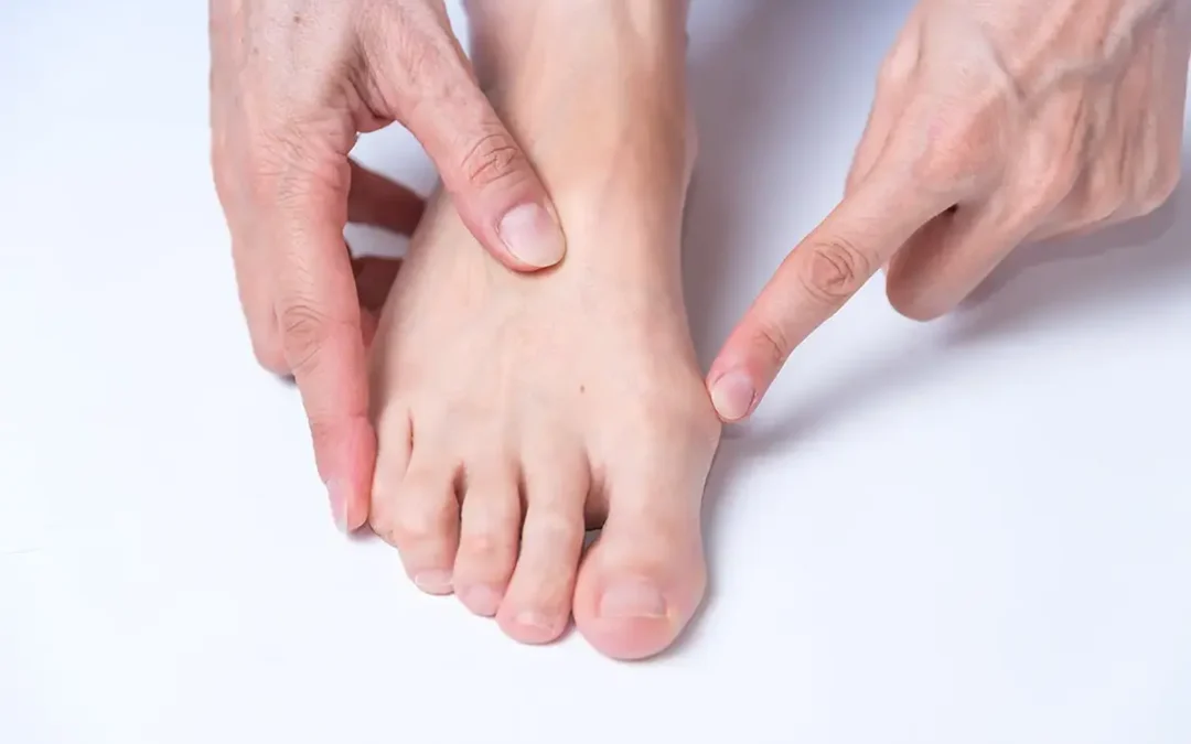 How Runners Can Address Bunions to Continue Training Pain-Free