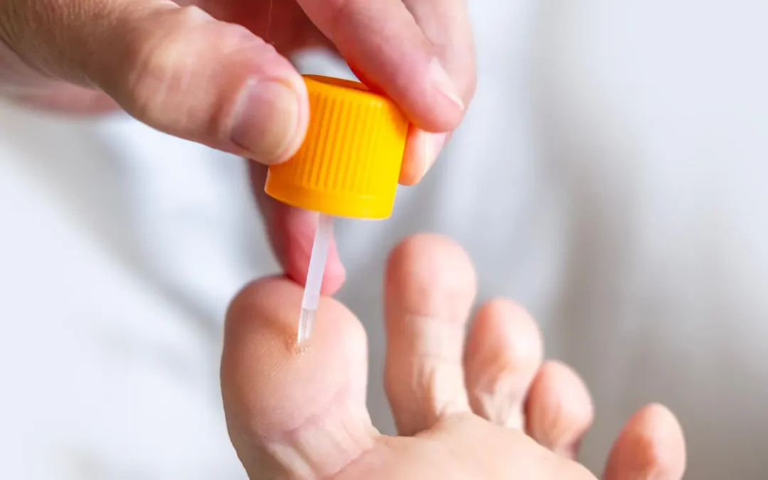 Using Salicylic Acid to Treat Corns: What You Should Know
