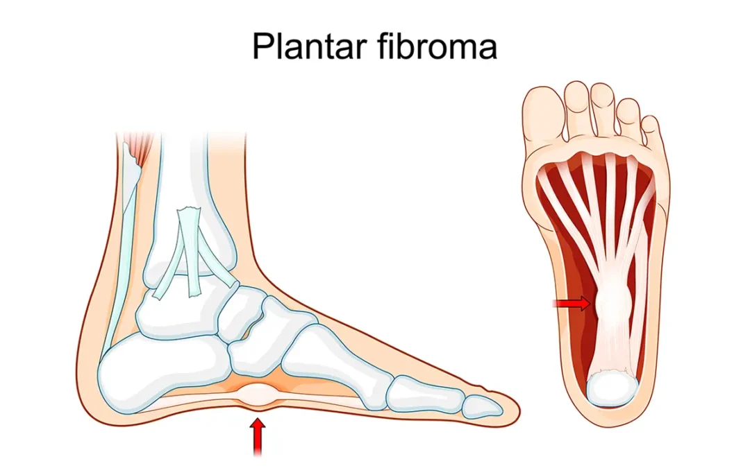 What Is a Plantar Fibroma? Symptoms and Treatment Insights