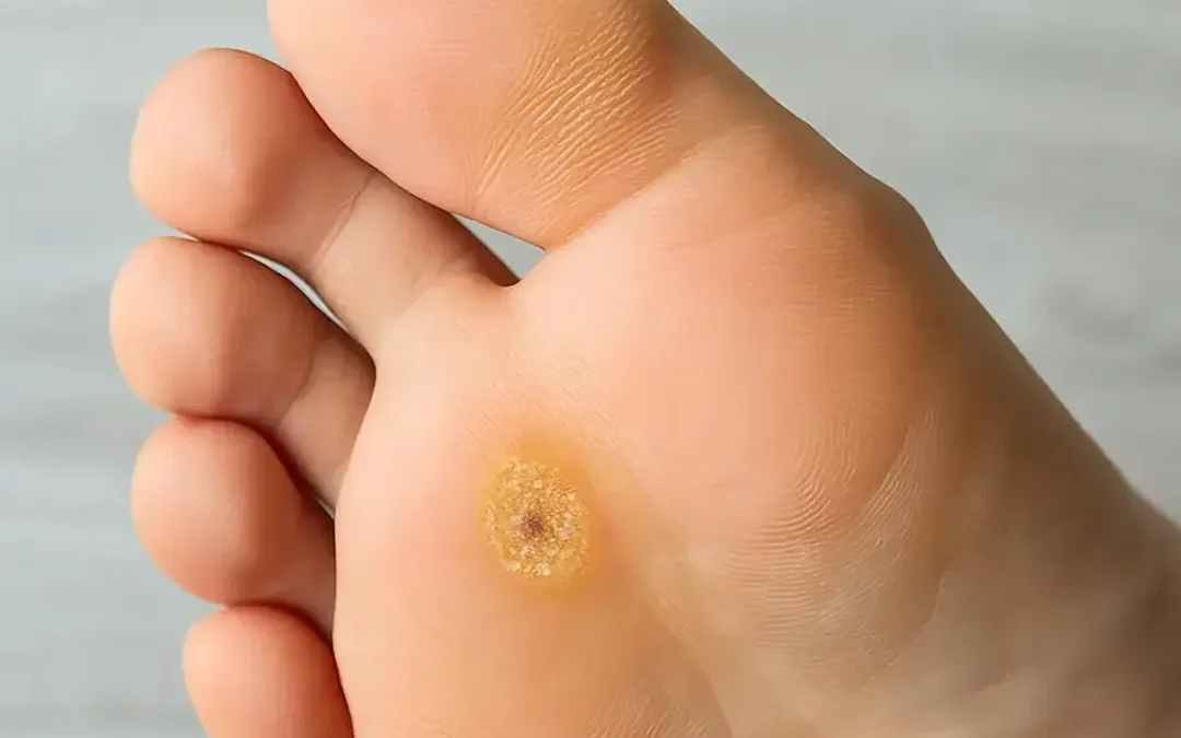 What Are Plantar Warts?