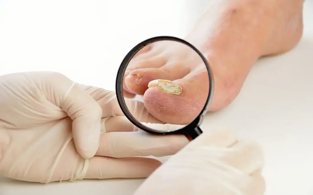 Different Types of Toenail Fungus and How to Identify Them