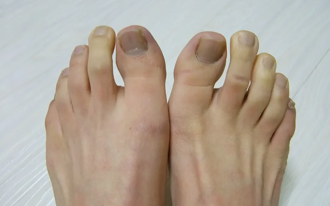 All About Raynaud’s Disease and Its Effects on Foot Health